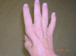 Muscle Atrophy and Weakness in Hand and Fingers Due to Pinched Ulnar Nerve